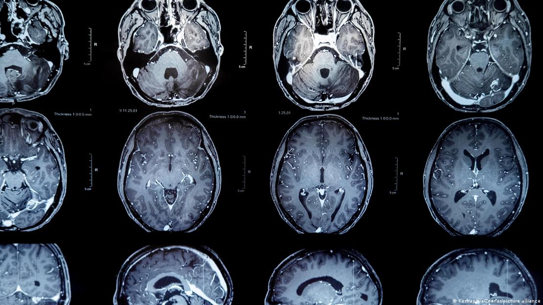 Un mapa celular para entender las enfermedades cerebrales